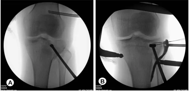 Fig. 1. Intraoperative fluoroscopic images. (A) Impactor was introduced through anterolateral tibial condyle