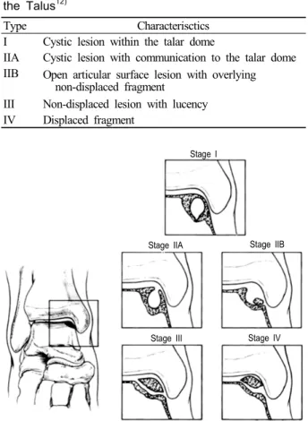 Table 4. CT Classification of Osteochondral Lesion of  the Talus 12)