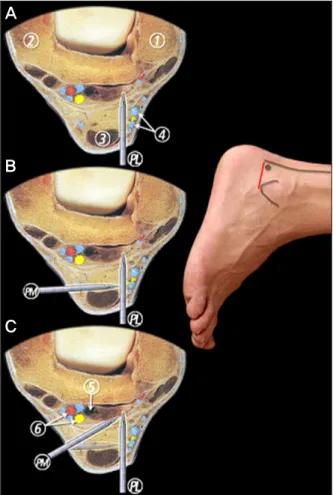 Figure 2. Posterolateral and posteromedial portal positions are  shown in relation to significant anatomic structures.