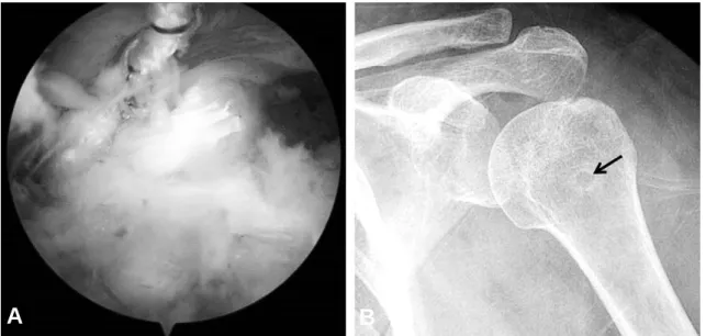 Fig. 1. Left shoulder of forty-seven years old woman. Arthroscopic photo (A) and plain x-ray (B) show the location of the biceps tenodesis