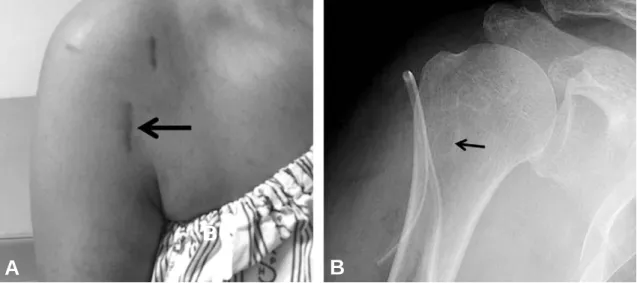 Fig. 3. Right shoulder of fifty-two years old woman. Clinical photo shows the severely damaged long head tendon of biceps cut from the proximal attachment