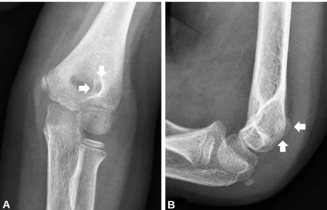Fig. 1. (A) Initial AP view of the elbow shows a 5x5mm sized radiolucent lesion with sclerotic margin in the lateral wall of the left olecranon fossa