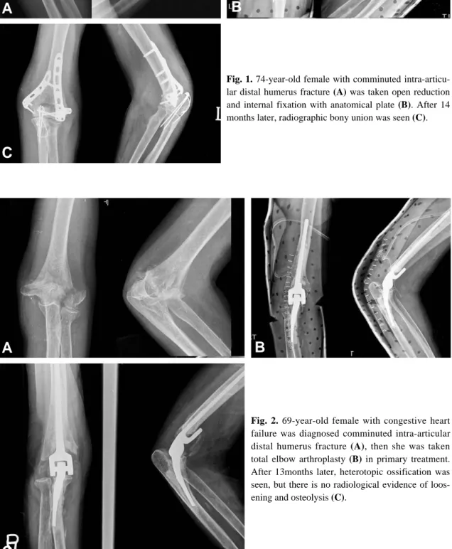 Fig. 2. 69-year-old female with congestive heart failure was diagnosed comminuted intra-articular distal humerus fracture (A), then she was taken total elbow arthroplasty (B) in primary treatment.