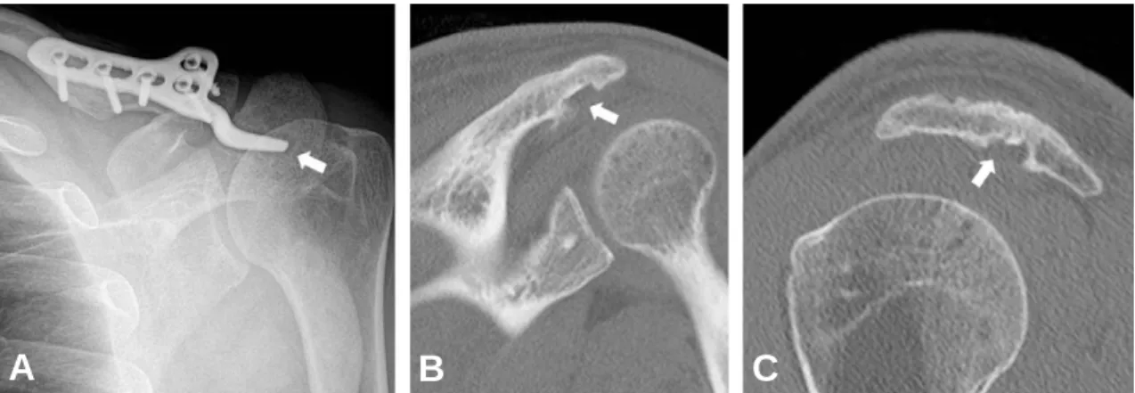 Fig. 3. Complications of AO hook plate. (A) Imaging study was obtained in a 39-year-old male who had been treated by AO hook plate