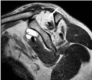 Fig. 3. Preoperative MRI oblique sagittal view shows severe fatty degeneration(white arrow) of supraspinatus.