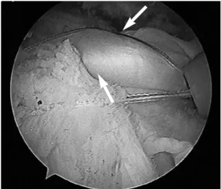 Fig. 6. The arthroscopic findings showed water tightly repaired rotator cuff by UU tension band suture (white arrow) in the above 49 years-old male.