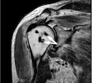 Fig. 7. At postoperative 4 months, oblique sagittal MRI findings showed that the suture anchor inserted proper position (whiet arrow) and supraspinatus tendon is intact (gray arrow head) in the above 49 years-old male.