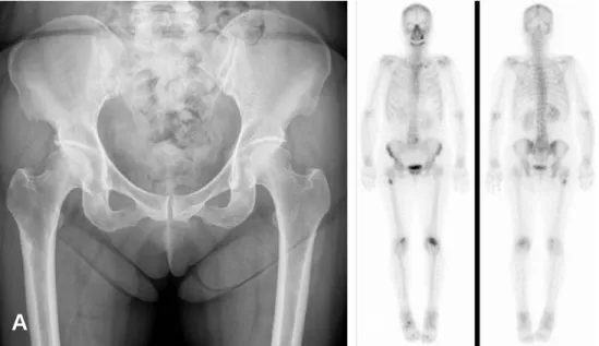 Fig. 1. (A) AP radiograph and (B) bone scan show external cortical reaction.