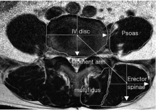 Fig. 1. MR axial image shows cross section of the mus- mus-cles at L4/5 disc level. IV Disc: L4/5  interverte-bral disc, moment arm length of the erector spinal muscle
