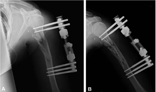 Fig. 2. Sequential postoperative anteroposterior X-ray images. (A) Radiograph shows a satisfactory alignment of fractured humerus with external fixator