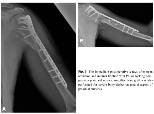 Fig. 3. The immediate postoperative x-rays after open reduction and internal fixation with Philos locking  com-pression plate and screws