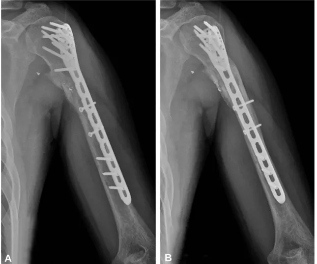 Fig. 4. After 3 months after internal fixation, bone union was obtained.
