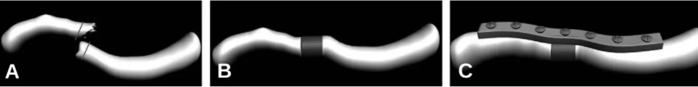 Fig. 1. Diagrams of intercalary iliac bone graft with plate fixation. (A-C) After sclerotic bone was excised to bleeding cortical bone, tricortical iliac bone graft was interposed to provide structural support and restore clavicle length and then plate and