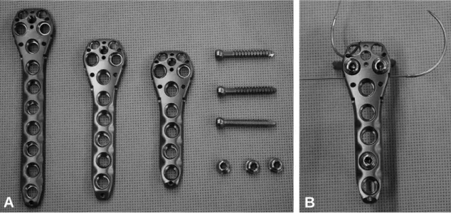 Fig. 1. (A) The NCB plate is a new fixed-angle device that locks the screws to the plate by secondary insertion of a locking cap and polyaxial (30 degrees radius) screw placement