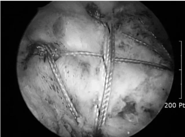 Fig. 1. Arthroscopic image from lateral portal shows repaired rotator cuff with single row technique.