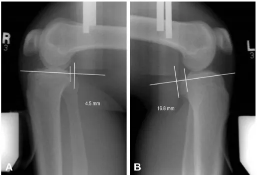 Fig. 1. Posterior stress radiograph using Telos stress arthrometer indicates 12.3 mm posterior translocation of tibia compared to the normal contralateral side