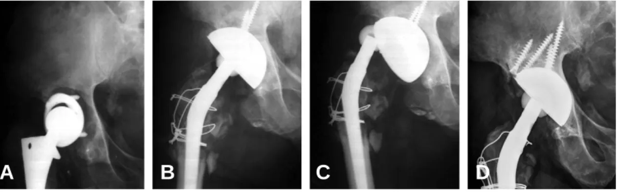 Fig. 1. The radiographs of a 58 year old male with loosening THA. (A) Preoperative AP view shows cavitary and segmental acetabular bone defect