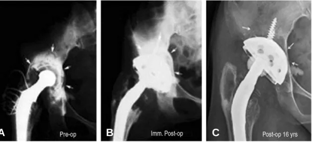 Fig. 4. 39 year-old female. (A) Preoperative anteroposterior view showed severe bone defects in zone I, II, and III.