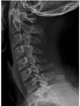 Fig. 1. Lateral cervical radiograph demonstrating spinous process fracture of C7
