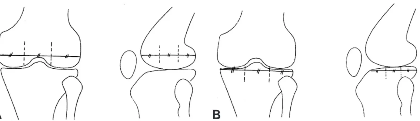 Fig. 1. Location of right femoral and tibial bone bruise. (A) Femur - In coronal and sagittal image, definite locational line is 3 divi- divi-sion of most longest line in each plane