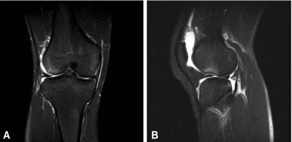 Fig. 3. Case of sports injury (MR image). (A) In T2WI coronal image, femur bone bruise is observed lateral condyle and tibia bone bruise located with lateral aspect