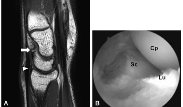 Fig. 2. (A) A MRI of an amateur basketball player sustained a repetitive hyperextension injury to his right wrist showed osteophytes at the dorsal aspects of the lunate (arrow) and dorsal capsular thickening occurred at the dorsal rim of the distal radius 