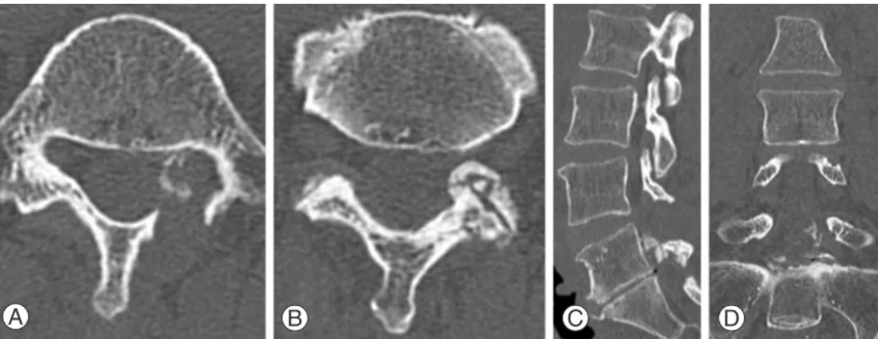 Fig. 1. (A) Axial view of the L5 showed the left L5 nerve root encircled by osteophytes