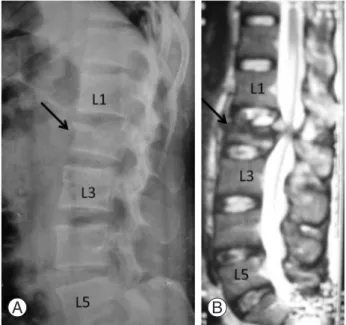 Fig. 1. Radiograph (A) and magnetic resonance imaging (B)  of the lumbar spine showing fracture of the L2 vertebra  (ar-row).