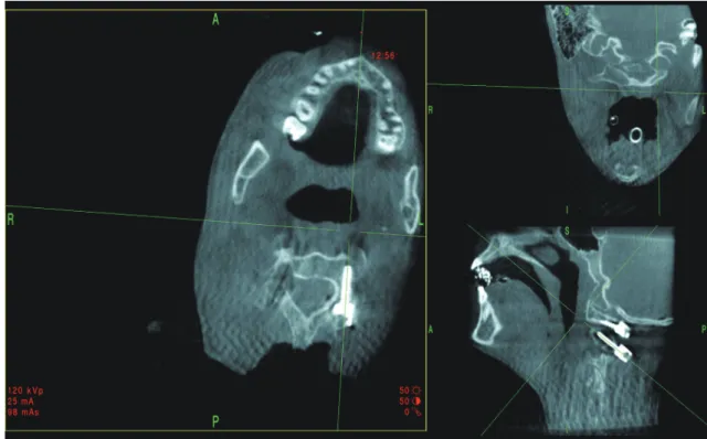 Fig. 2. Intraoperative reformatted computed tomography image using O-arm shows proper screw insertion into  the left C2 pedicle.