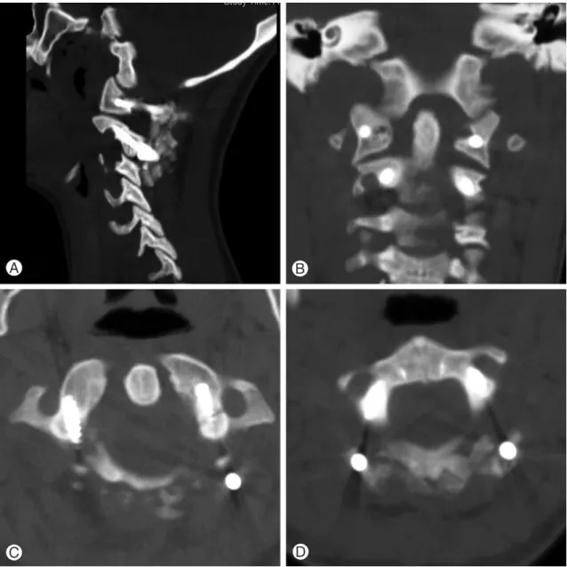 Fig. 4. (A) Postoperative computed tomography (CT) bone window, sagittal view image shows the proper  screw placement of the C1 lateral mass and C2 pedicle screws
