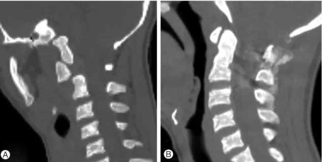 Fig. 5. (A) Preoperative computed tomography (CT) bone window sagittal view at the level of C1-C2 shows  the C1-C2 rotatory subluxation and displacement