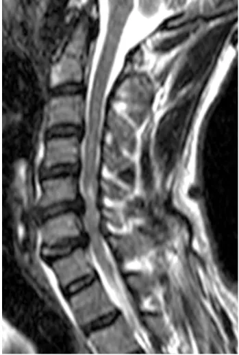 Fig. 2. Sagittal reconstruction of computed tomography (CT) images showing motion-induced artifacts mim- mim-icking cervical dens fracture (white arrow)