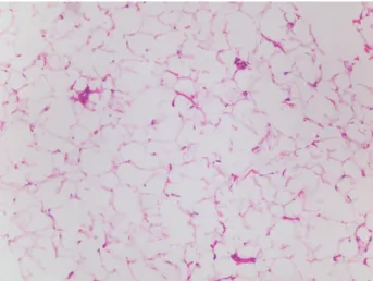 Fig. 4. Microscopic findings confirmed mature adipose tis- tis-sue with large adipocytes (H&amp;E, ×100).