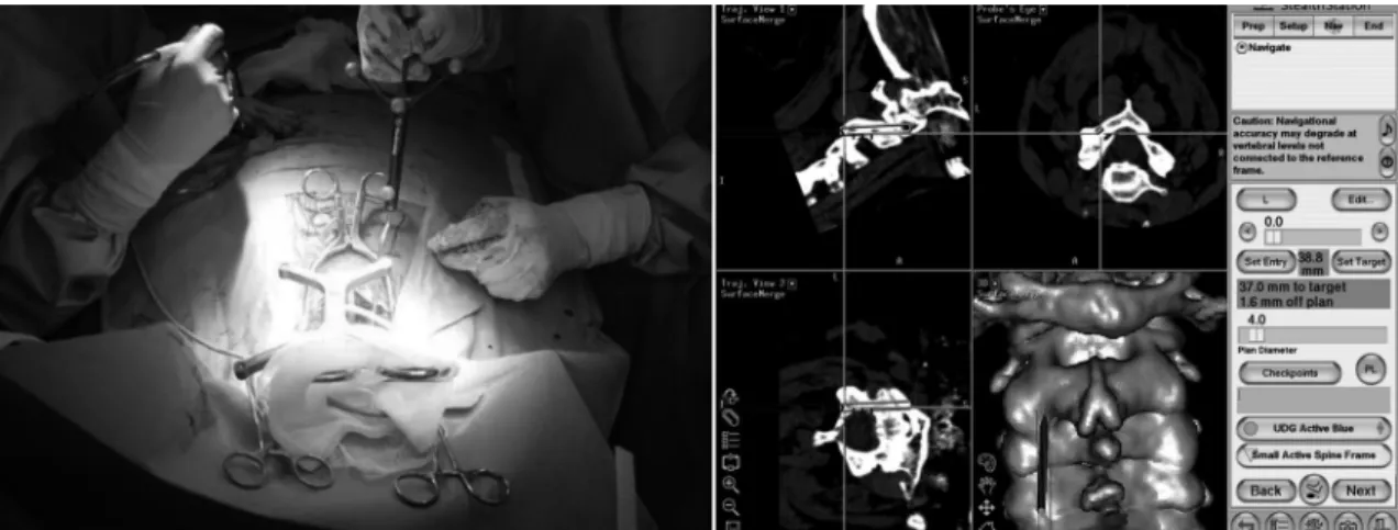 Fig. 1. The direction of screw insertion was determined using a probe, then the screw insertion position was es- es-tablished