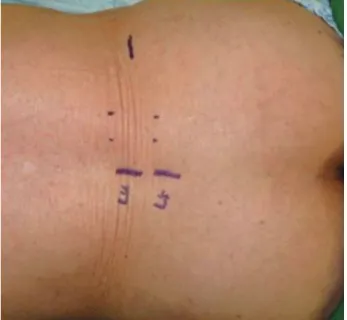 Fig. 1. Marking of L4-5 spinous process and iliac crest as  surface anatomical landmarks.