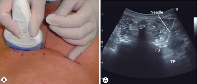 Fig. 3. Needle insertion between the superior articular process and on the upper edge of the transverse process