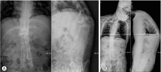 Fig. 1. Preoperative radiogram (58-year-old male, ankylosing spondylitis with kyphosis and Andersson’s  lesion)