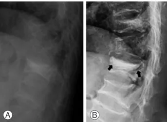 Table 1. Anterior vertebral height and kyphotic angle