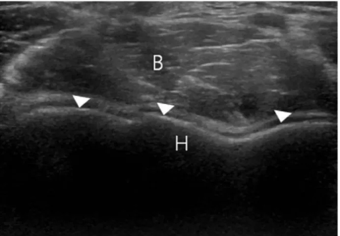 Fig. 2. (A) Transverse image of biceps brachii tendon (arrow head) is showing in just lateral of brachial artery (Ba) at the level of distal humerus