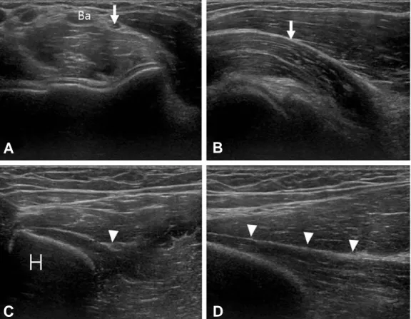 Fig. 3. (A) Transverse image of median nerve (arrow) is showing in just medial of brachial artery (Ba) at the level of distal humerus