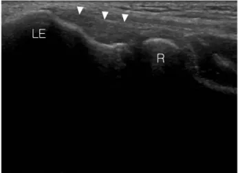 Fig. 5. Longitudinal image of radial collateral ligament image is demonstrating (arrow head).