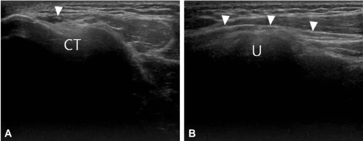 Fig. 7. Fibers of ulnar collateral ligament (arrow heads) is showing in the longitudinal image of medial elbow joint