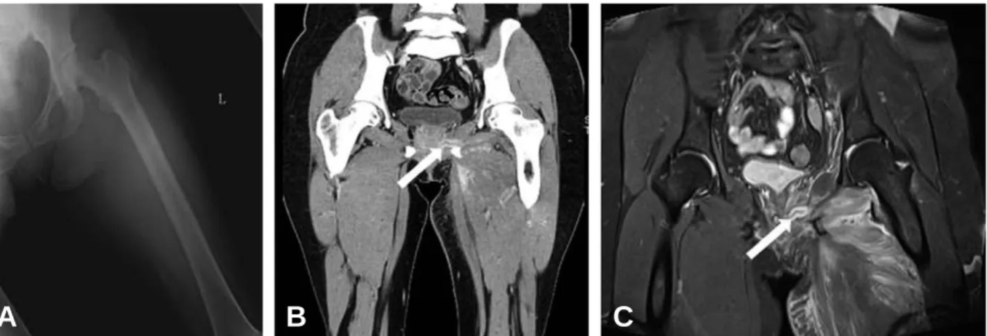 Fig. 2. High resolution ultrasonography shows tubular echogenic lesion (arrow) surrounding diffuse low echoic lesion suggesting there are foreign bodies in inguinal area