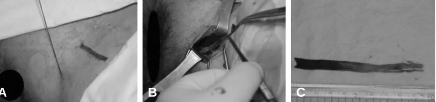 Fig. 3. (A) Before operation, the tip of long needle was located at foreign bodies under the ultrasonographic guid- guid-ance