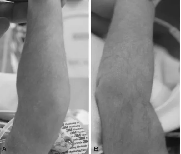 Fig. 1. Clinical photography of both elbow shows no significant difference between affected side (A) and normal side (B).