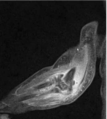 Fig. 3. Enhanced T1 weighted image coronal MR images shows increased joint effusion with  dif-fuse soft tissue enhancement around the right elbow joint.