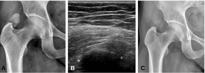 Fig. 2. (A) External oblique radiograph of 34-years-old female shows faint calcification adjacent to right AIIS