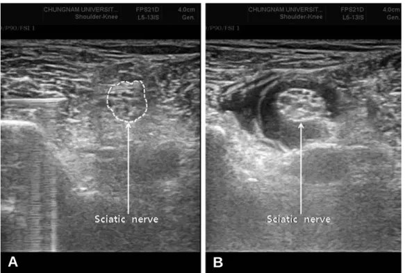 Fig. 4. (A) Ultrasound image shows left sciatic nerve at mid-thigh level proximal to popliteal fossa
