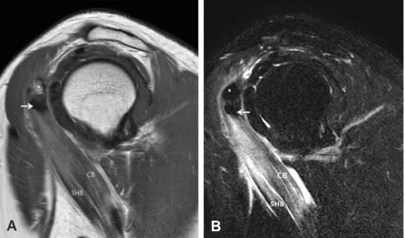 Fig. 1. MRI finding shows low signal intensity, nodular shape calcium deposition within conjoined tendon (arrow).