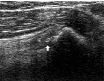 Fig. 4. In 8 months follow up, calcification nodule have changed into small calcific spot (yellow arrow).